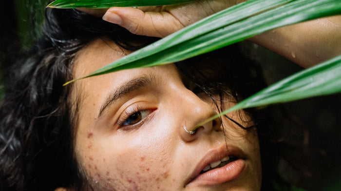 Dark haired woman with acne behind a plant